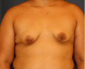 Feel Beautiful - Breast Augmentation Lift 53 - Before Photo